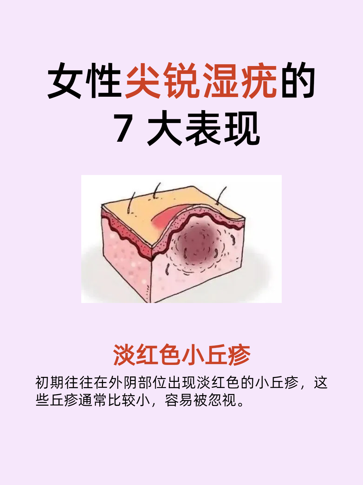 尖锐湿疣初期症状图片_(尖锐湿疣初期症状图片口腔)